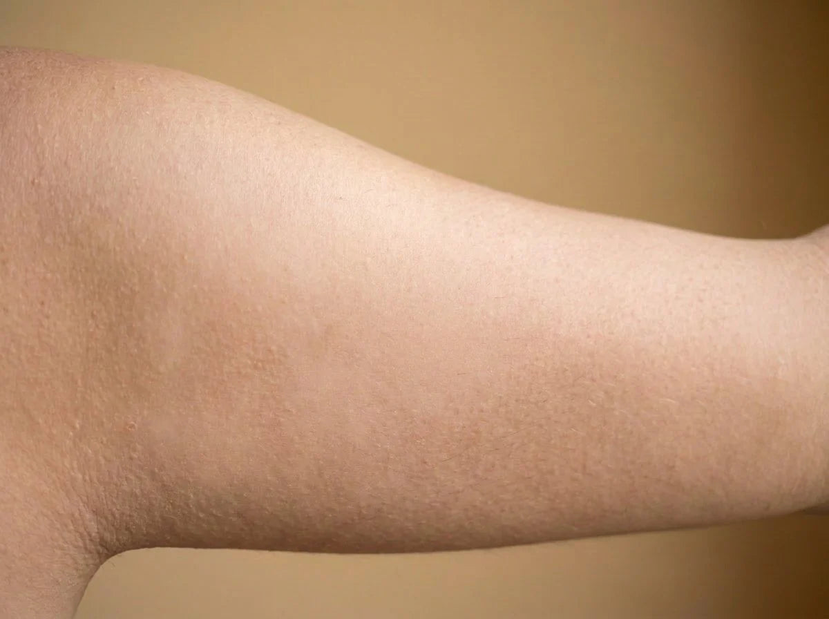 After about four weeks — smoother, more even skin