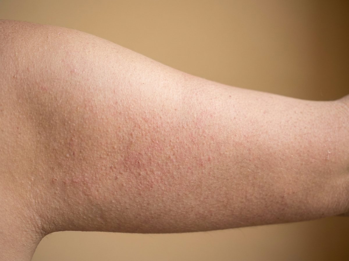 Before — bumpy, uneven skin