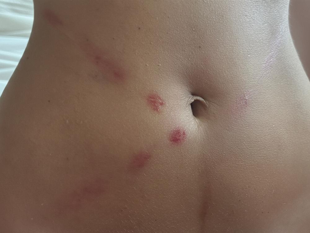 After weeks of daily use — marks visibly fainter and calmer