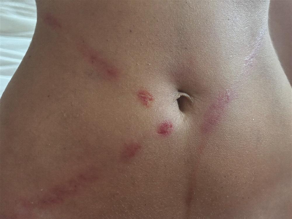 Fresh pink stretch marks across a postpartum belly